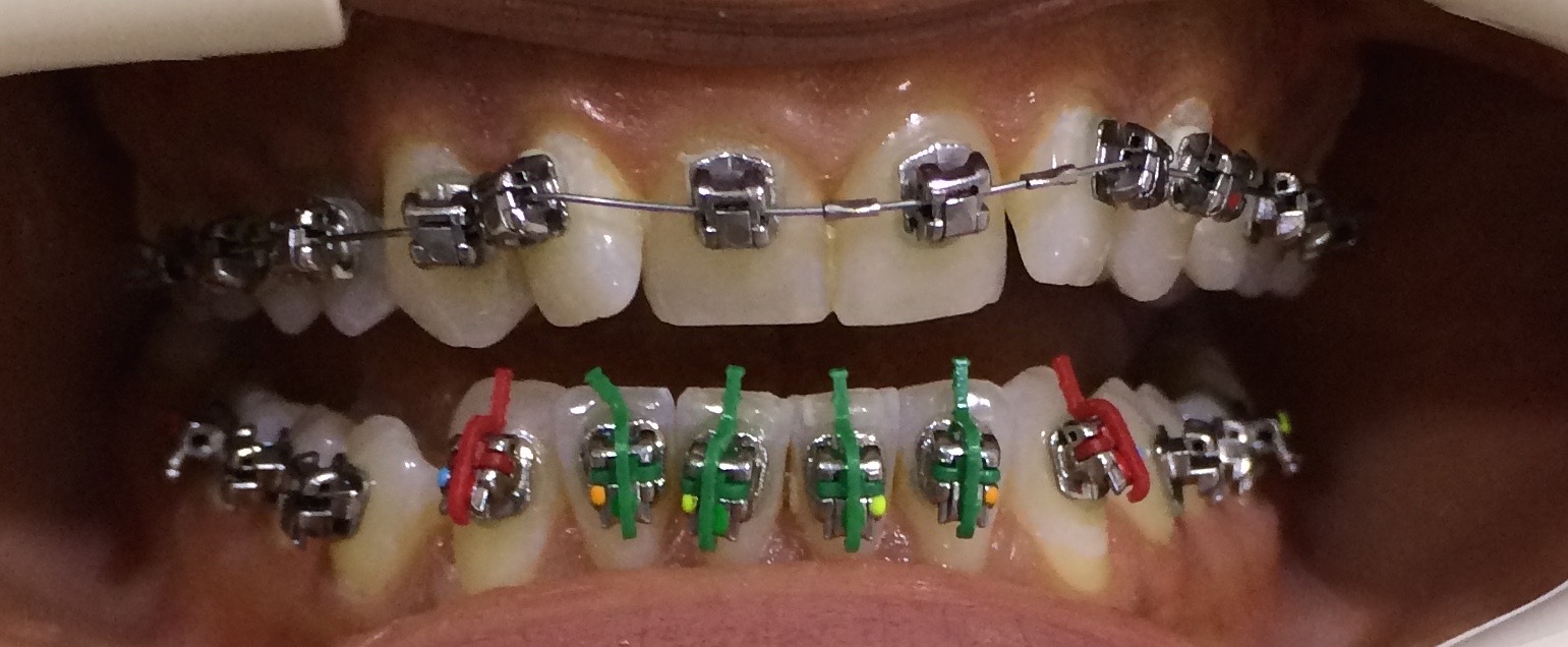 Precision Bracket Placement