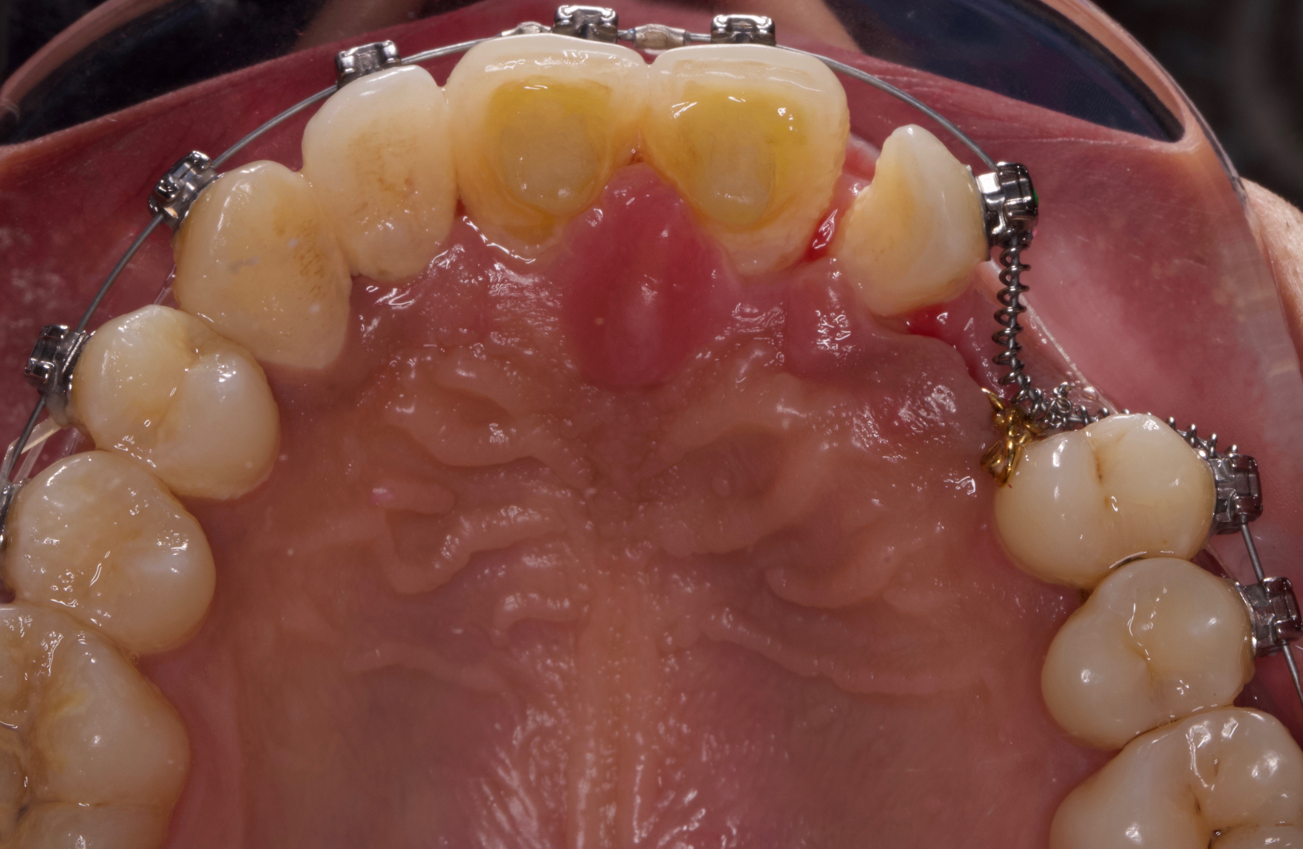 Palatal Traction and Realignment